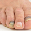 Màu sắc móng chân tiết lộ tình trạng sức khỏe của bạn
