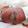 Bình Phước: Một trẻ sơ sinh bị bỏng nặng do sưởi ấm bằng than