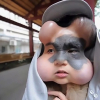 Căn bệnh kỳ lạ khiến cô gái khổ sở vì 4 trái bóng trên mặt