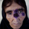 Kỳ quái bệnh nhiệt đen ở những vùng IS chiếm đóng tại Syria, Iraq