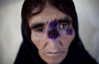 Kỳ quái bệnh nhiệt đen ở những vùng IS chiếm đóng tại Syria, Iraq