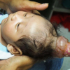 Philippines: Bé trai “mọc sừng” trên đầu khiến bác sĩ sửng sốt