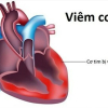 Bệnh viêm cơ tim là gì?