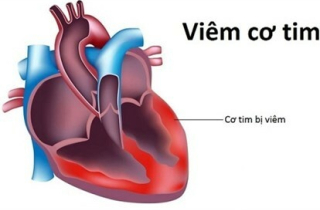 Bệnh viêm cơ tim là gì?