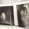 Thẩm mỹ viện Emcas hút mỡ bụng cho phụ nữ đang mang thai 8 tuần