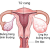 Phụ nữ nào dễ bị ung thư buồng trứng?