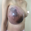 Thai phụ chịu đựng khối u khổng lồ ở ngực chờ sinh con mới mổ