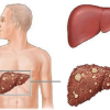 Bước tiến trong điều trị ung thư gan