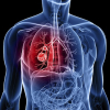 Nguyên nhân nào dẫn đến bệnh ung thư phổi