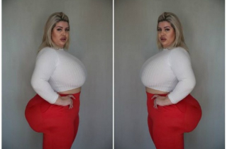 Cô gái phẫu thuật bơm mông liên tục để có vòng ba khủng