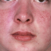 Bệnh lupus ban đỏ được hiểu như thế nào?