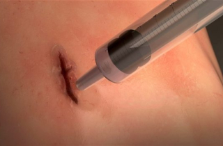 Keo chữa lành vết thương trong vài giây