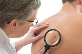 Ung thư da di căn được hiểu như thế nào?