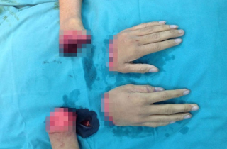 Hai bàn tay đứt rời hoàn toàn phục hồi kỳ diệu sau ghép nối