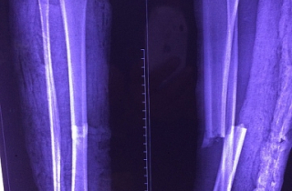 Bệnh nhân bị tuyến trên từ chối, tuyến huyện mổ được