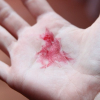 Ho ra máu: dấu hiệu của nhiều căn bệnh nguy hiểm