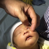 Bé gái 15 ngày tuổi bị loét giác mạc do mẹ nhỏ sữa vào mắt