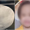 Sức khoẻ bé gái 3 tuổi ở Hà Nội bị đinh ghim vào đầu hiện thế nào?