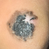 Phát hiện ung thư tế bào hắc tố từ đốm đen ở gót chân