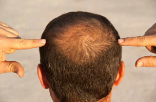 7 dấu hiệu cảnh báo chứng rụng tóc của bạn đang ở mức báo động