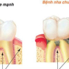 Đánh răng sai cách là nguyên nhân gây ra nhiều bệnh ung thư