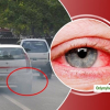Ô nhiễm do khói xe: Nguyên nhân hàng đầu gây các bệnh về mắt