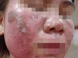 'Vỡ mộng' da đẹp đón Tết: Tan nát mặt vì tự peel da theo hướng dẫn trên mạng