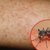 Những triệu chứng thường gặp nhưng dễ gây nhầm lẫn với sốt xuất huyết