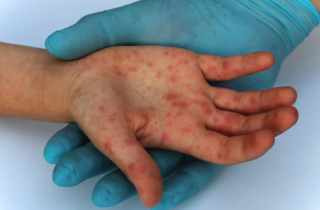 Thái Lan họp khẩn để đối phó với bệnh đậu mùa khỉ