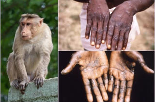 TP.HCM ghi nhận ca bệnh đậu mùa khỉ đầu tiên