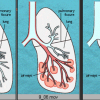 Bệnh phổi kẽ tiến triển nhanh và tiên lượng xấu hơn cả ung thư
