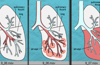 Bệnh phổi kẽ tiến triển nhanh và tiên lượng xấu hơn cả ung thư