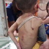 Bé trai 1 tuổi, cơ thể đầy thương tích, nghi bị bạo hành