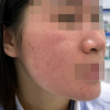 Bỏng da mặt vì dùng chanh tươi trị mụn