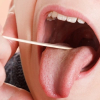 Loét miệng ba tháng không lành, đến viện khám phát hiện ung thư