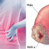 Những dấu hiệu âm thầm của ung thư thận dễ bị bỏ qua