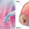 Dấu hiệu âm thầm của ung thư thận dễ bị bỏ qua