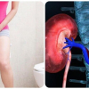 5 dấu hiệu thận đang quá tải và cần đi khám gấp
