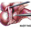 Dấu hiệu điển hình khi viêm ruột thừa