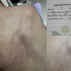 Bé gái 4 tuổi bị cô giáo ném vào tường, đánh tím lưng: Bộ Y tế vào cuộc