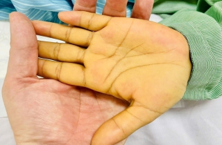 Sụt cân, mệt mỏi - cảnh báo sớm của ung thư gan ít ai ngờ