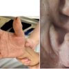 Chích máu đầu ngón tay cứu đột quỵ: Cứu người hay rước họa?