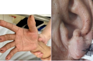 Chích máu đầu ngón tay cứu đột quỵ: Cứu người hay rước họa?