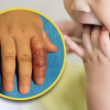 Mẹ dùng băng quấn để ngăn con mút tay, em bé suýt phải cắt cụt ngón
