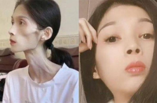 Số phận bi thảm của cô gái xinh đẹp biến thành 'bộ xương di động' 17kg
