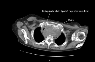 Suýt mất mạng vì chủ quan với bướu giáp lành tính