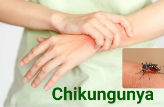 Nhóm người nguy cơ mắc bệnh Chikungunya