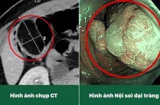 Phẫu thuật nội soi hoàn toàn cắt u đại tràng 5cm cho du khách Canada