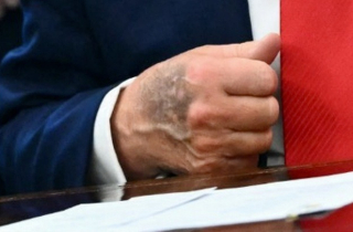 Bàn tay thâm tím của ông Trump gây chú ý