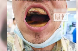 Hàm răng đáng sợ của người đàn ông tự mua nhựa về trám, nha sỹ bất lực